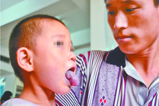 5岁的成成患了先天性血管瘤压喉，舌头和嘴唇已经变成了紫黑色。 记者李鹏飞 摄