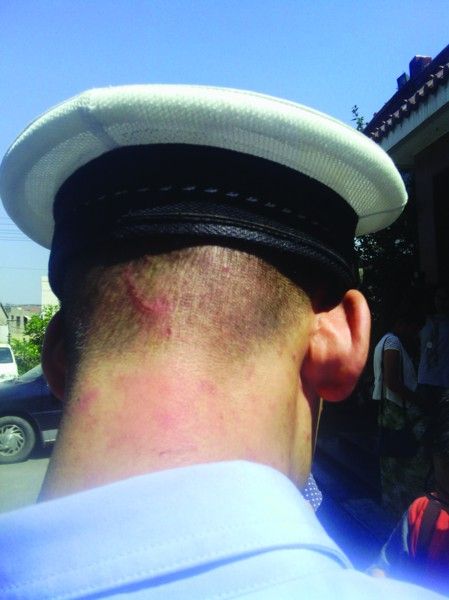 民警被咬的伤口　记者朱彩玲摄